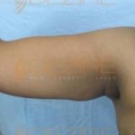 Arm Fat Reduce Surgery in Pune India