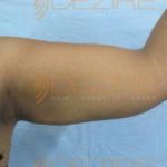 Arm Fat Removal Surgery Before After Pune