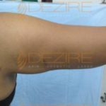 Arm Fat Removal Surgery in Low cost Pune India