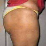 Back Fat Removal Surgery Cost In Pune
