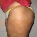 Back Fat Removal Surgery Low Cost In Pune