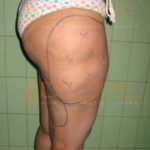 Back Thigh Fat Removal Surgery Cost in Pune