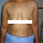 Belly Fat Freezing Procedure Pune