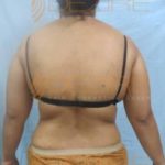Belly Fat Removal Price in Pune