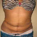 Belly Fat Removal Procedures in Before After Photo