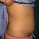 Belly Fat Removal Procedures in Pune