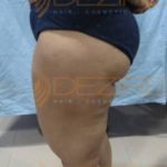 Belly Fat Removal Pune