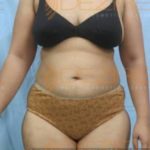 Belly Fat Removal in Pune