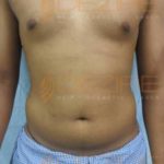 Belly Fat Removal in pune