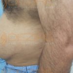 Belly Fat Surgery Affordable Prices in Pune