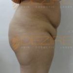 Best Non Surgical Fat Removal Pune