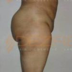 Best Non Surgical Fat Removal Surgery Pune