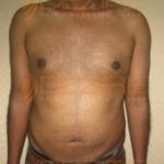 Body Fat Reduction Before After in Pune