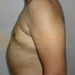 Coolsculpting Areas Of The Body in Pune Side Effect