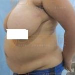 Coolsculpting Arms in pune