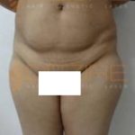 Coolsculpting Thighs low Cost Pune