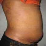 Coolsculpting Treatment Permant in Pune