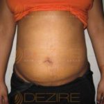 Coolsculpting Treatment in Pune