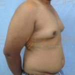 Excess Fat Removal in Pune