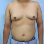 Excess Fat Removal in Pune India