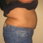 Fat Freezing Treatment Before After in Pune
