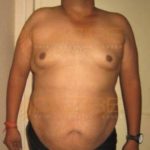 Fat Reduction Laser Treatment in Safe Or Not