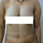 Fat Reduction Non Surgical Pune
