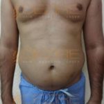 Fat Reduction Non Surgical in Pune India