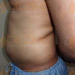 Fat Reduction Non Surgical in Pune World