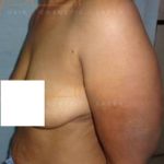 Fat Removal From Stomach Without Surgery Post Care in Pune