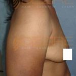 Fat Removal From Stomach Without Surgery in Pune World