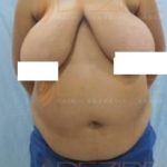 Fat Removal Lasers Without Surgery Price in Pune
