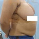 Fat Removal Lasers Without Surgery Side Effect in Pune