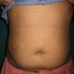 Fat Removal Non Invasive in Pune India