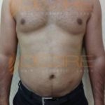 Fat Removal Surgery Before After Photo Pune