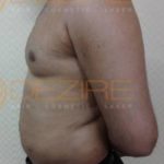 Fat Removal Surgery Options Result Pune