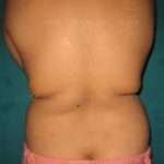 Fat Removal Without Surgery
