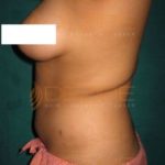 Fat Removal Without Surgery in Pune