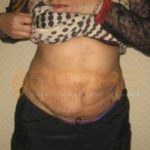 Fat Suction Without Surgery in Recover Time Pune