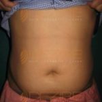Freeze Fat Away Before And After Pune