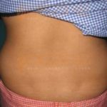 Freeze Fat Away Before And After Treatment Pune