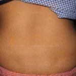 Freeze Fat Away Before And After surgery Pune