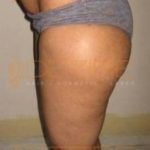Freeze Fat Therapy Cost in Pune