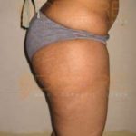 Freeze Fat Therapy Side Effect in Pune