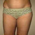 Freeze Fat Therapy in Pune World