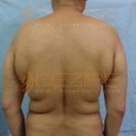 Freeze Off Fat Procedure Before After Photo Pune
