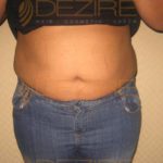 Freeze Off Fat Procedure Before After Pune
