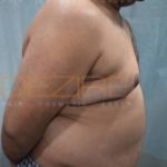 Freeze Off Fat Procedure Low Price in Pune