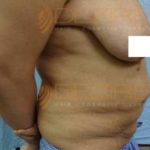 Freeze Off Fat Procedure Recover time Pune