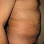 Freeze Weight Loss surgery Cost in Pune India